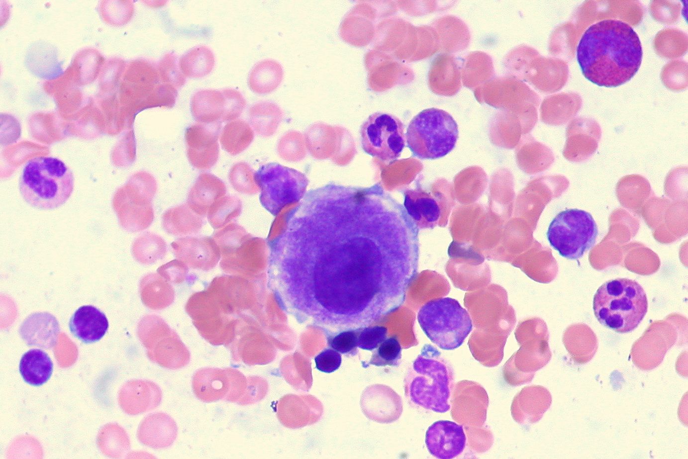 Myelodysplastic syndrome - Simple English Wikipedia, the free encyclopedia