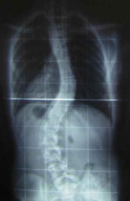 Adolescent idiopathic scoliosis - Wikipedia