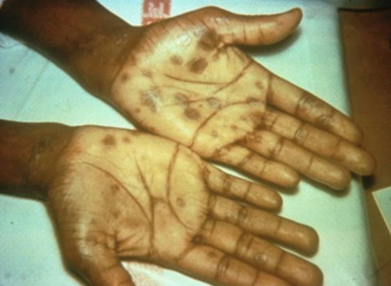 Ficheiro:Secondary syphilis-palmar rash.PNG – Wikipédia, a enciclopédia livre