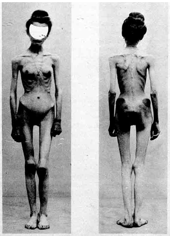 File:Anorexia case 1900.jpg - Wikimedia Commons