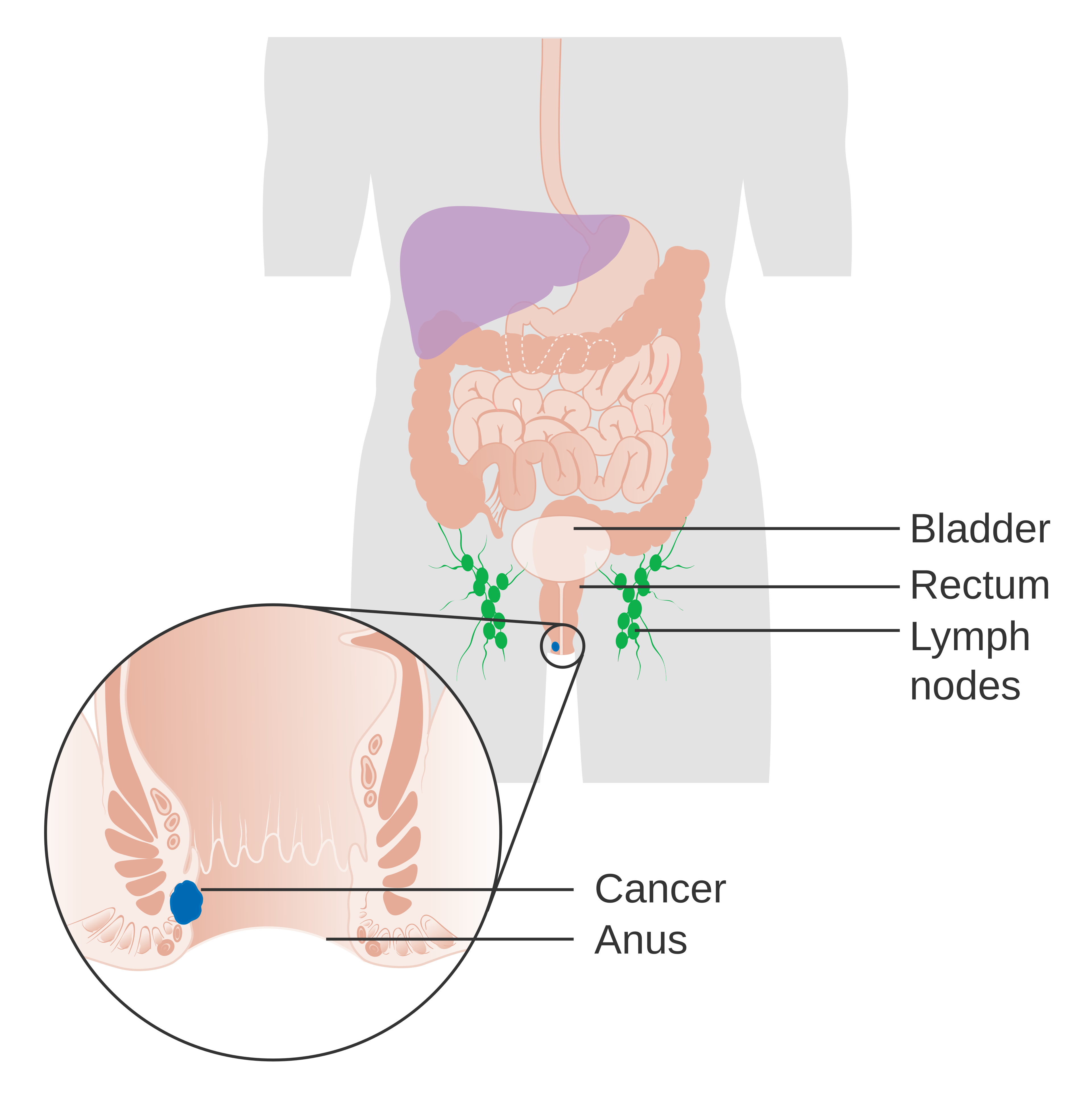 File:Diagram showing stage 1 anal cancer CRUK 189.svg - Wikimedia Commons