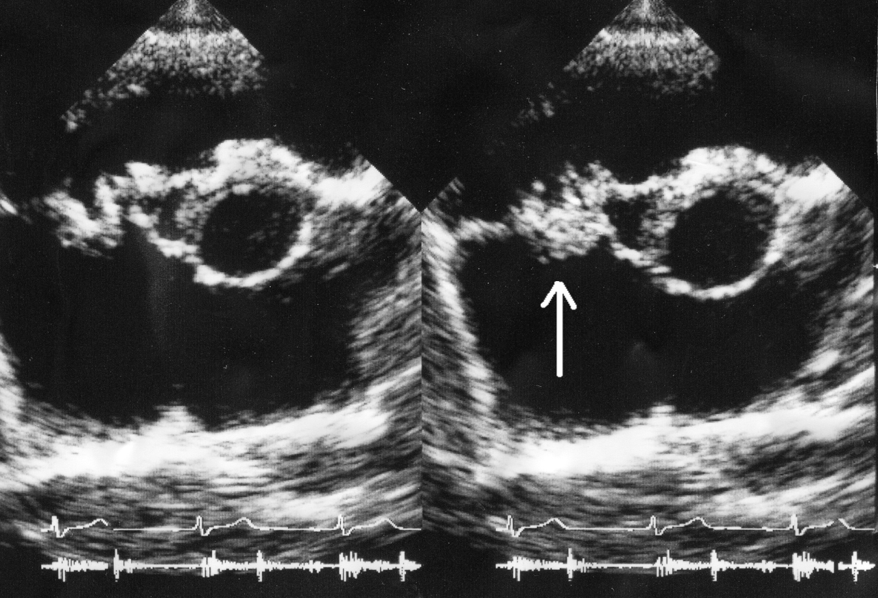 File:Endocarditis ultrasound.gif - Wikimedia Commons