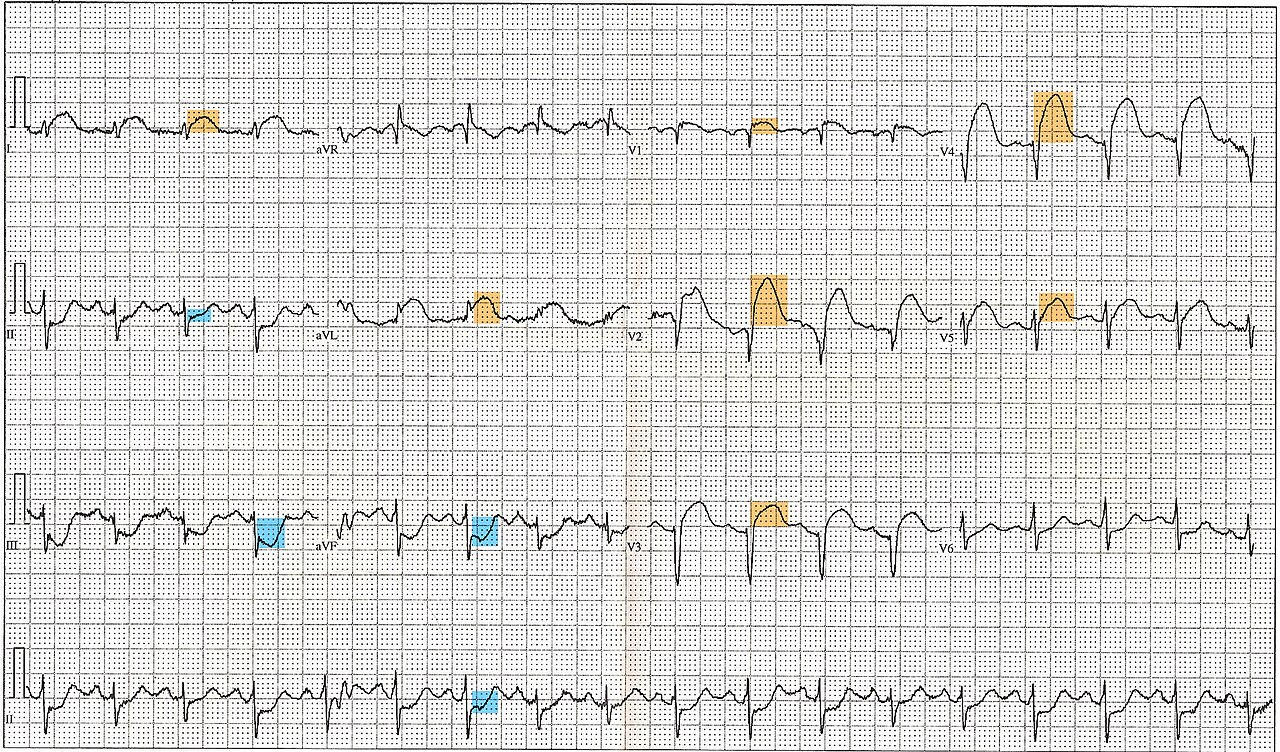 Electrocardiography in myocardial infarction - Wikipedia