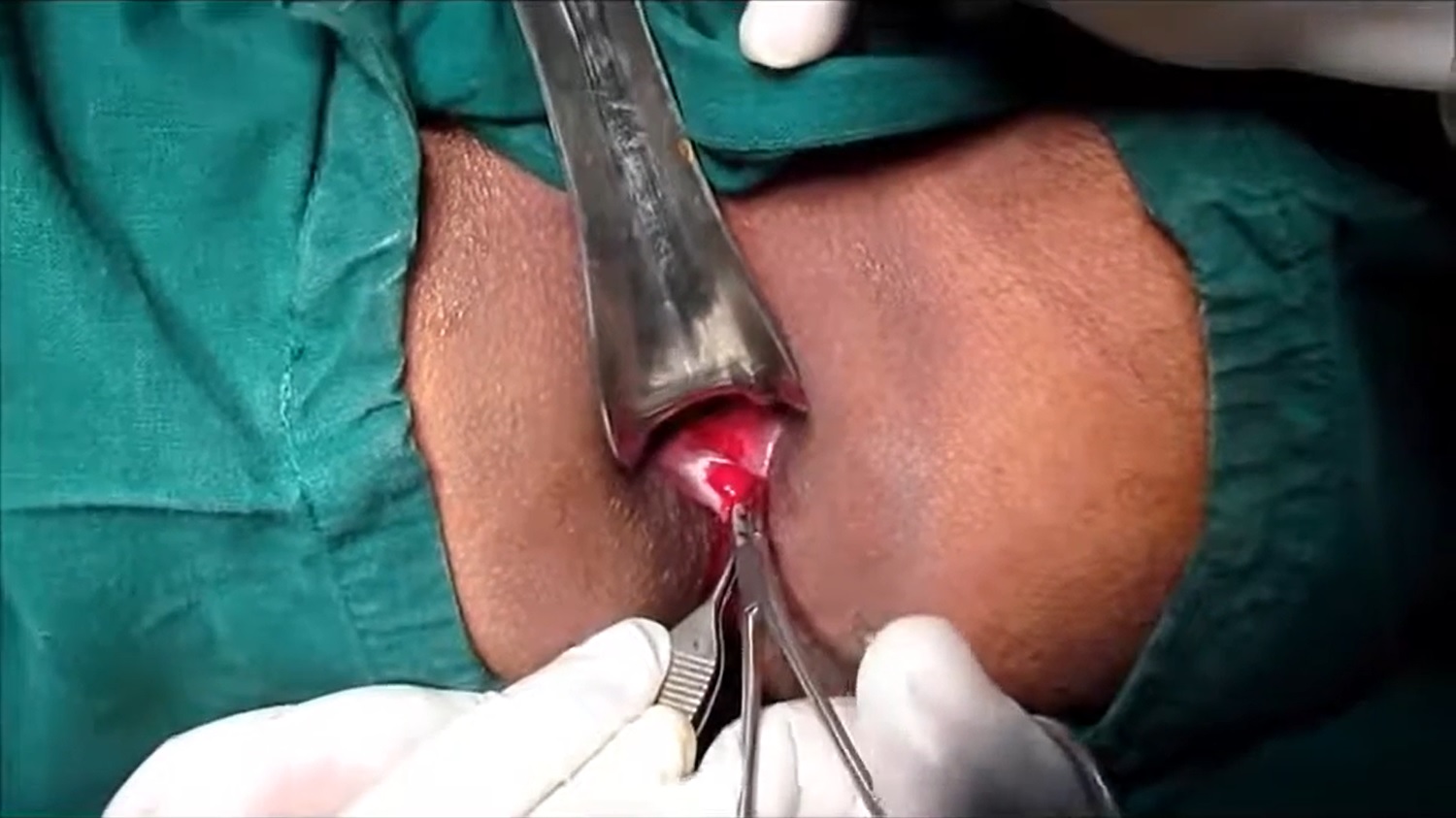File:Anal Fissure Treatment-Lateral Sphincterotomy.jpg - Wikimedia Commons