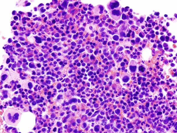 Essential thrombocythemia - Wikipedia