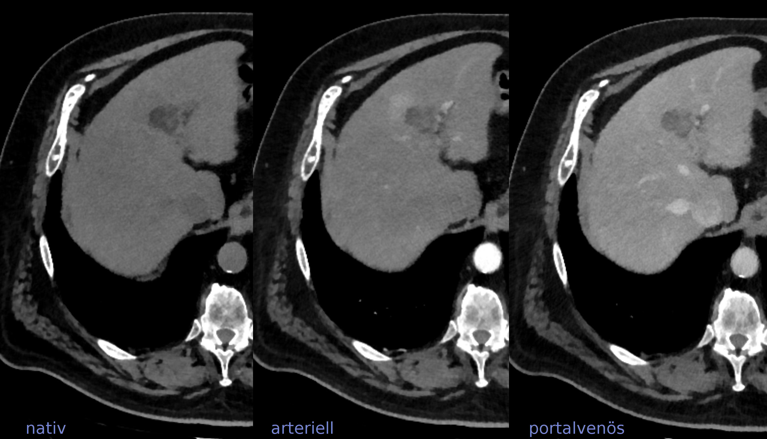 hepatocellular carcinoma | pacs