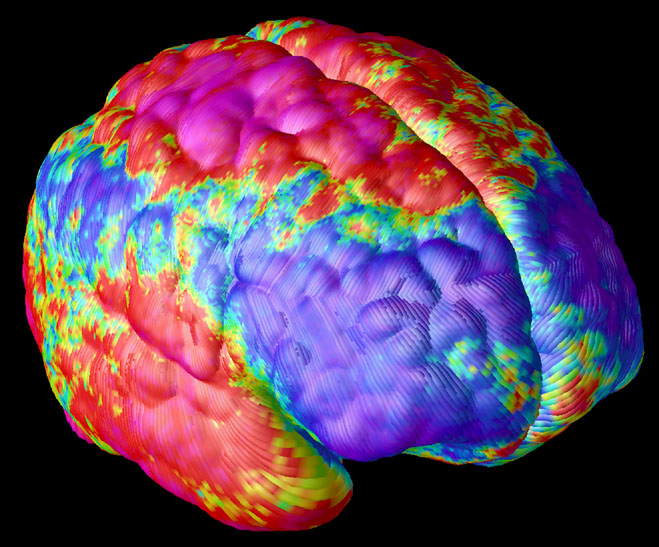 File:SchizophreniaBrain.jpg - Wikimedia Commons